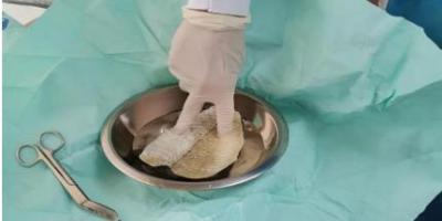 Injertos de piel de tilapia, una alternativa efectiva para las quemaduras