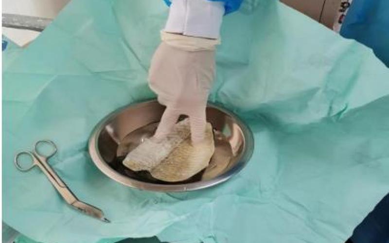 Injertos de piel de tilapia, una alternativa efectiva para las quemaduras