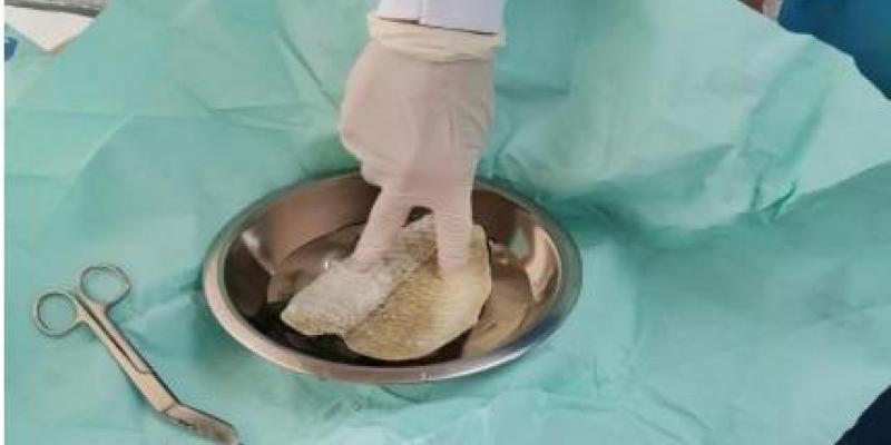 Injertos de piel de tilapia, una alternativa efectiva para las quemaduras